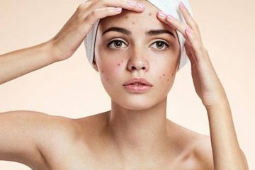 Cách trị sẹo thâm tại nhà do mụn trứng cá để lại