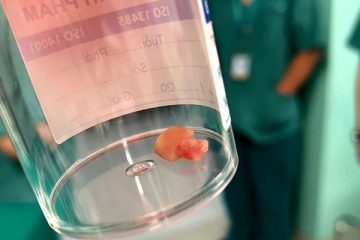 Bé gái 3 tuổi bị hóc đậu phộng nhưng chẩn đoán nhầm là viêm phổi