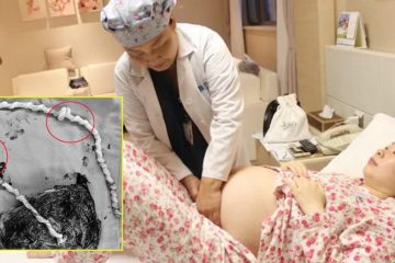 Mổ đẻ cho mẹ bầu 35 tuần, bác sĩ choáng váng khi nhìn dây rốn 20 năm chưa từng gặp