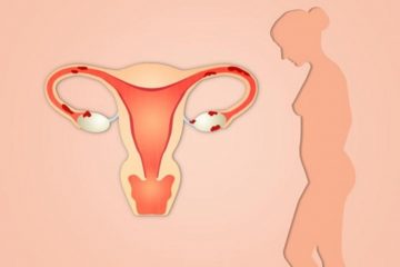 Viêm nội mạc tử cung – Những điều bạn nên biết