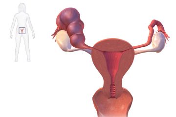 Ứ dịch vòi trứng là gì? Nguyên nhân do đâu, có gây vô sinh không?