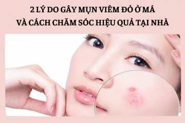 Mách chị em 2 lý do khiến mụn viêm đỏ xuất hiện ồ ạt trên má khiến bạn mất tự tin