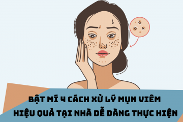 Gợi ý 4 cách trị mụn viêm hiệu quả, an toàn dễ thực hiện tại nhà