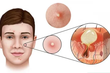 Nên hay không nên nặn mụn viêm tại nhà